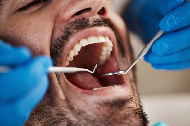 Best Knocked-Out Tooth (Avulsed Tooth) Treatment in Woody, WA